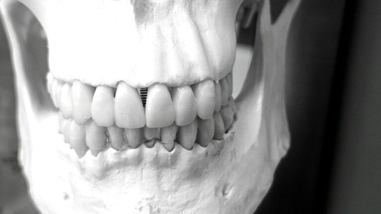 implantes dentales precio
